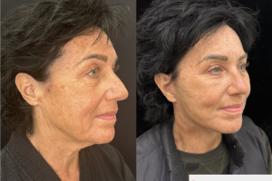 60-y.o-female-Awake-Deep-Plane-Facelift-Necklift-Upper-and-Lower-Blepharoplasty-and-Facial-Fat-Transfer-1-5