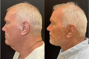 62-y.o-male-Deep-Plane-Facelift-and-Necklift-1-1