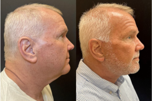 62-y.o-male-Deep-Plane-Facelift-and-Necklift-1-2