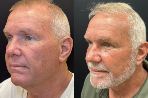 62-y.o-male-Deep-Plane-Facelift-and-Necklift-1-3
