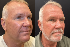 62-y.o-male-Deep-Plane-Facelift-and-Necklift-1-4