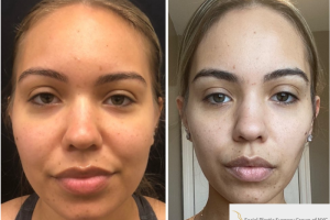 32-y.o-Facial-Slimming-Surgery-which-included-Buccal-Fat-Reduction-and-Chin-Neck-Liposculpting-1-1