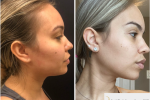 32-y.o-Facial-Slimming-Surgery-which-included-Buccal-Fat-Reduction-and-Chin-Neck-Liposculpting-1-2
