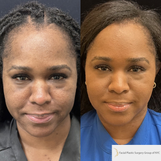 JW-40-y.o-female-who-is-2-months-out-from-Buccal-fat-reduction