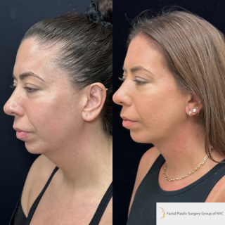 LD-34-y.o-female-who-is-3-months-out-from-central-Necklift.-There-is-no-incision-around-the-ear-1-1