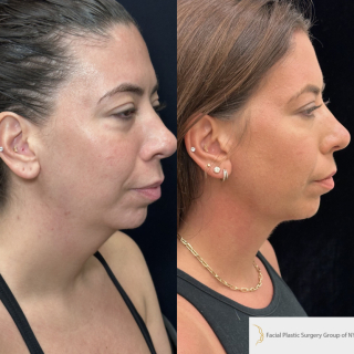 LD-34-y.o-female-who-is-3-months-out-from-central-Necklift.-There-is-no-incision-around-the-ear-1-2