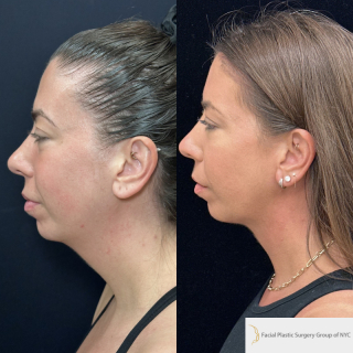 LD-34-y.o-female-who-is-3-months-out-from-central-Necklift.-There-is-no-incision-around-the-ear-1-3
