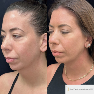 LD-34-y.o-female-who-is-3-months-out-from-central-Necklift.-There-is-no-incision-around-the-ear-1-4