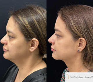 CA-40-y.o-female-who-is-3-months-out-from-Chin-Neck-Liposculpting-1-1