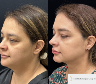 CA-40-y.o-female-who-is-3-months-out-from-Chin-Neck-Liposculpting-1-2