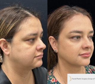 CA-40-y.o-female-who-is-3-months-out-from-Chin-Neck-Liposculpting-1-3