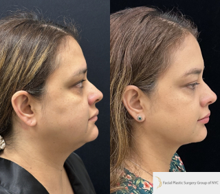 CA-40-y.o-female-who-is-3-months-out-from-Chin-Neck-Liposculpting-1-4
