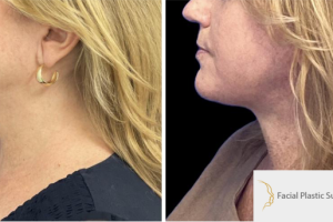 47-y.o-female-who-underwent-Deep-Plane-Facelift-Extended-Deep-plane-Neck-Lift-1