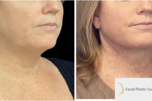 47-y.o-female-who-underwent-Deep-Plane-Facelift-Extended-Deep-plane-Neck-Lift-2