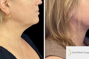 47-y.o-female-who-underwent-Deep-Plane-Facelift-Extended-Deep-plane-Neck-Lift-3