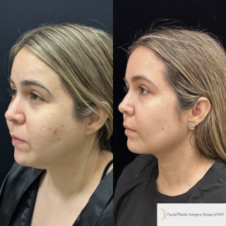 FR-23-y.o-female-who-is-3-months-out-from-Chin-Neck-Liposculpting-with-skin-tightening-and-Buccal-Fat-Reduction-1-1