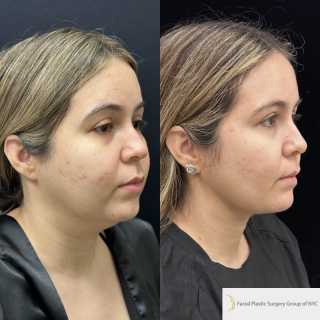 FR-23-y.o-female-who-is-3-months-out-from-Chin-Neck-Liposculpting-with-skin-tightening-and-Buccal-Fat-Reduction-1-2