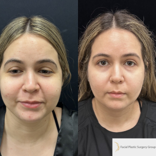 FR-23-y.o-female-who-is-3-months-out-from-Chin-Neck-Liposculpting-with-skin-tightening-and-Buccal-Fat-Reduction-1-3