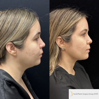 FR-23-y.o-female-who-is-3-months-out-from-Chin-Neck-Liposculpting-with-skin-tightening-and-Buccal-Fat-Reduction-1-4