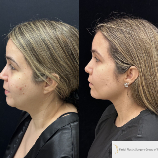 FR-23-y.o-female-who-is-3-months-out-from-Chin-Neck-Liposculpting-with-skin-tightening-and-Buccal-Fat-Reduction-1-5