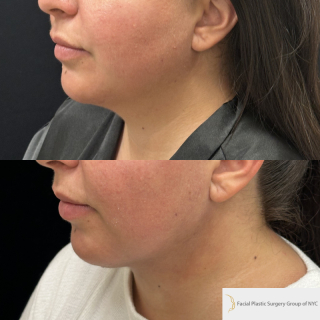 GC-34-y.o-female-who-is-3-months-out-from-Chin-and-Neck-Liposculpting-with-skin-tightening-1-1
