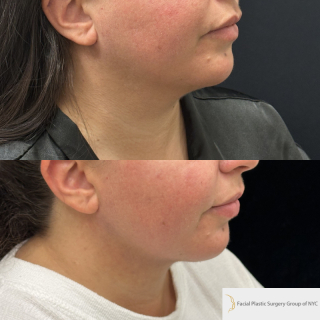 GC-34-y.o-female-who-is-3-months-out-from-Chin-and-Neck-Liposculpting-with-skin-tightening-1-2