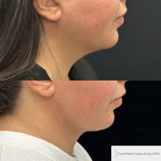 GC-34-y.o-female-who-is-3-months-out-from-Chin-and-Neck-Liposculpting-with-skin-tightening-1-3