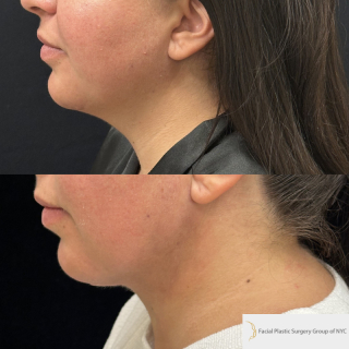 GC-34-y.o-female-who-is-3-months-out-from-Chin-and-Neck-Liposculpting-with-skin-tightening-1-4