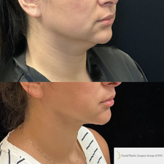 KP-34-y.o-female-who-is-6-months-out-from-chin-and-neck-liposuction-with-skin-tightening-1-1