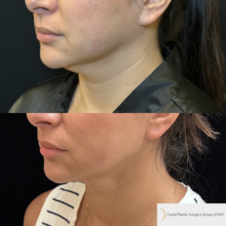 KP-34-y.o-female-who-is-6-months-out-from-chin-and-neck-liposuction-with-skin-tightening-1-2