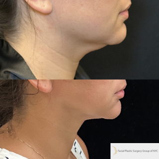 KP-34-y.o-female-who-is-6-months-out-from-chin-and-neck-liposuction-with-skin-tightening-1-3