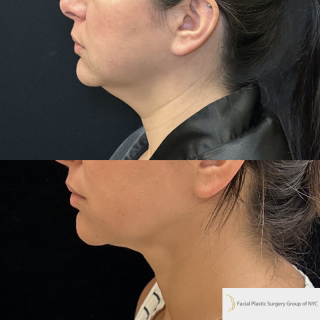 KP-34-y.o-female-who-is-6-months-out-from-chin-and-neck-liposuction-with-skin-tightening-1-4