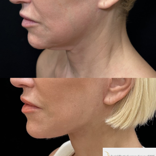 AH-51-y.o-female-who-is-now-3-months-out-from-Deep-Plane-Facelift-Necklift-and-CO2-laser-Resurfacing-1-1