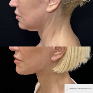 AH-51-y.o-female-who-is-now-3-months-out-from-Deep-Plane-Facelift-Necklift-and-CO2-laser-Resurfacing-1-2