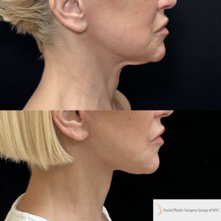 AH-51-y.o-female-who-is-now-3-months-out-from-Deep-Plane-Facelift-Necklift-and-CO2-laser-Resurfacing-1-3