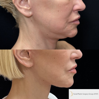 AH-51-y.o-female-who-is-now-3-months-out-from-Deep-Plane-Facelift-Necklift-and-CO2-laser-Resurfacing-1-4