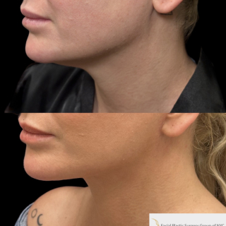 AK-45-y.o-female-who-is-now-6-months-out-from-Deep-Plane-Facelift-Necklift-and-Lower-Blepharoplasty-1-1