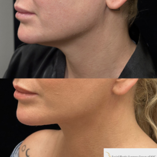 AK-45-y.o-female-who-is-now-6-months-out-from-Deep-Plane-Facelift-Necklift-and-Lower-Blepharoplasty-1-2