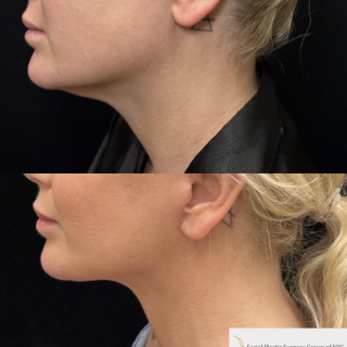 AK-45-y.o-female-who-is-now-6-months-out-from-Deep-Plane-Facelift-Necklift-and-Lower-Blepharoplasty-1-4