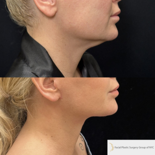 AK-45-y.o-female-who-is-now-6-months-out-from-Deep-Plane-Facelift-Necklift-and-Lower-Blepharoplasty-1-5