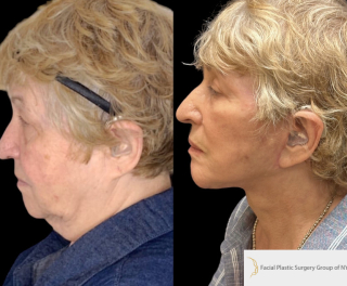 AM-71-y.o-female-who-is-3-months-out-from-Deep-Plane-Facelift-Necklift-1-1