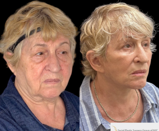 AM-71-y.o-female-who-is-3-months-out-from-Deep-Plane-Facelift-Necklift-1-2