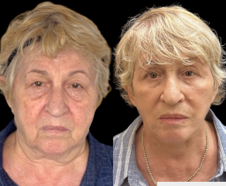 AM-71-y.o-female-who-is-3-months-out-from-Deep-Plane-Facelift-Necklift-1-3