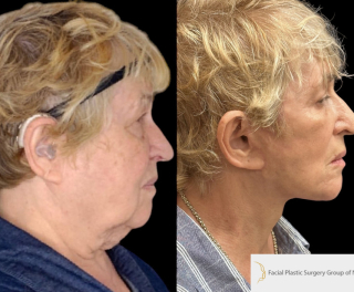 AM-71-y.o-female-who-is-3-months-out-from-Deep-Plane-Facelift-Necklift-1-4