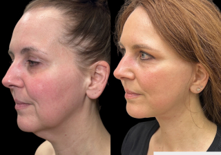 CB-50-y.o-female-who-had-massive-weight-loss-and-underwent-Deep-Plane-Facelift-and-Necklift.-She-is-now-3-months-out-from-the-surgery-1-1