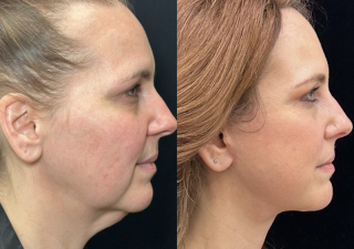 CB-50-y.o-female-who-had-massive-weight-loss-and-underwent-Deep-Plane-Facelift-and-Necklift.-She-is-now-3-months-out-from-the-surgery-1-2