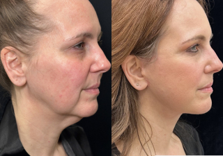 CB-50-y.o-female-who-had-massive-weight-loss-and-underwent-Deep-Plane-Facelift-and-Necklift.-She-is-now-3-months-out-from-the-surgery-1-3