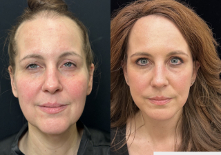 CB-50-y.o-female-who-had-massive-weight-loss-and-underwent-Deep-Plane-Facelift-and-Necklift.-She-is-now-3-months-out-from-the-surgery-1-4