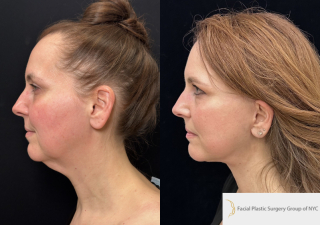 CB-50-y.o-female-who-had-massive-weight-loss-and-underwent-Deep-Plane-Facelift-and-Necklift.-She-is-now-3-months-out-from-the-surgery-1-5