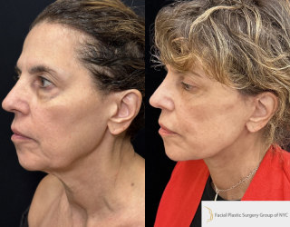 CC-71-y.o-female-who-is-3-months-out-from-Deep-Plane-Facelit-Necklift-Upper-and-lower-blepharoplasty-and-facial-fat-transfer-1-1